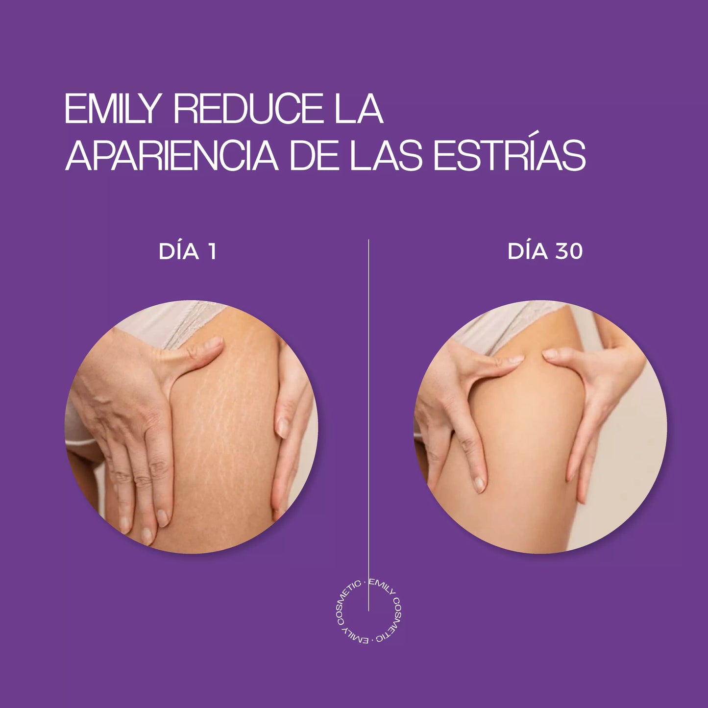 Crema para Estrías EMILY 200ml🧴🦵 con Jojoba, B5 y Ácido Hialurónico