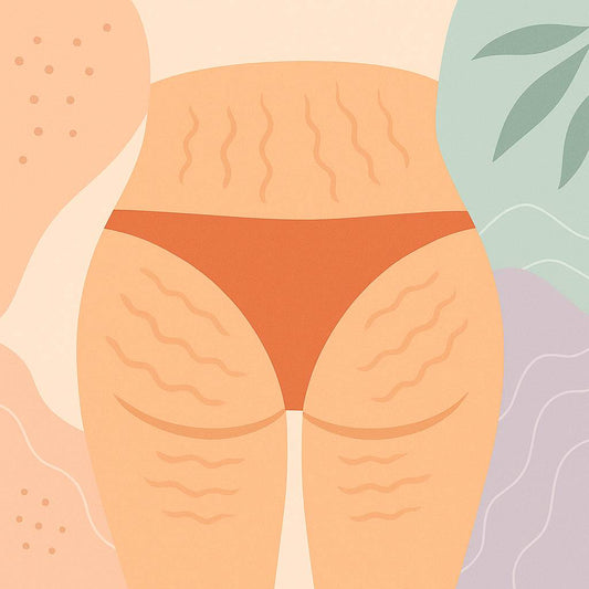 Celulitis en glúteos