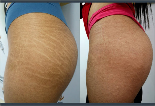 Crema antiestrías efectiva
