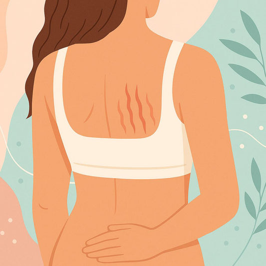 estrias en la espalda