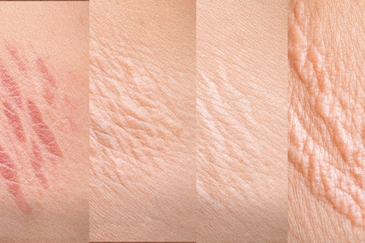 Tipos de estrías: cómo identificarlas y qué usar para tratarlas